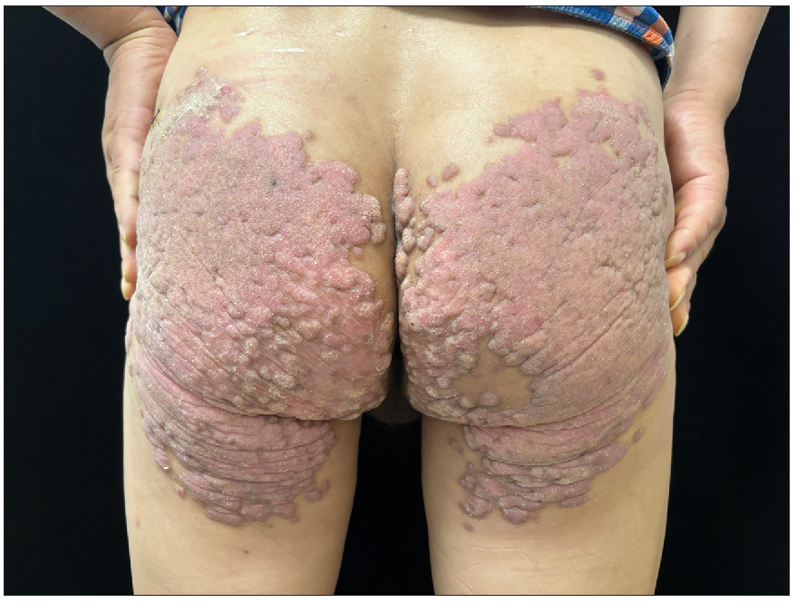 Butterfly-shaped hypertrophic plaques on buttocks