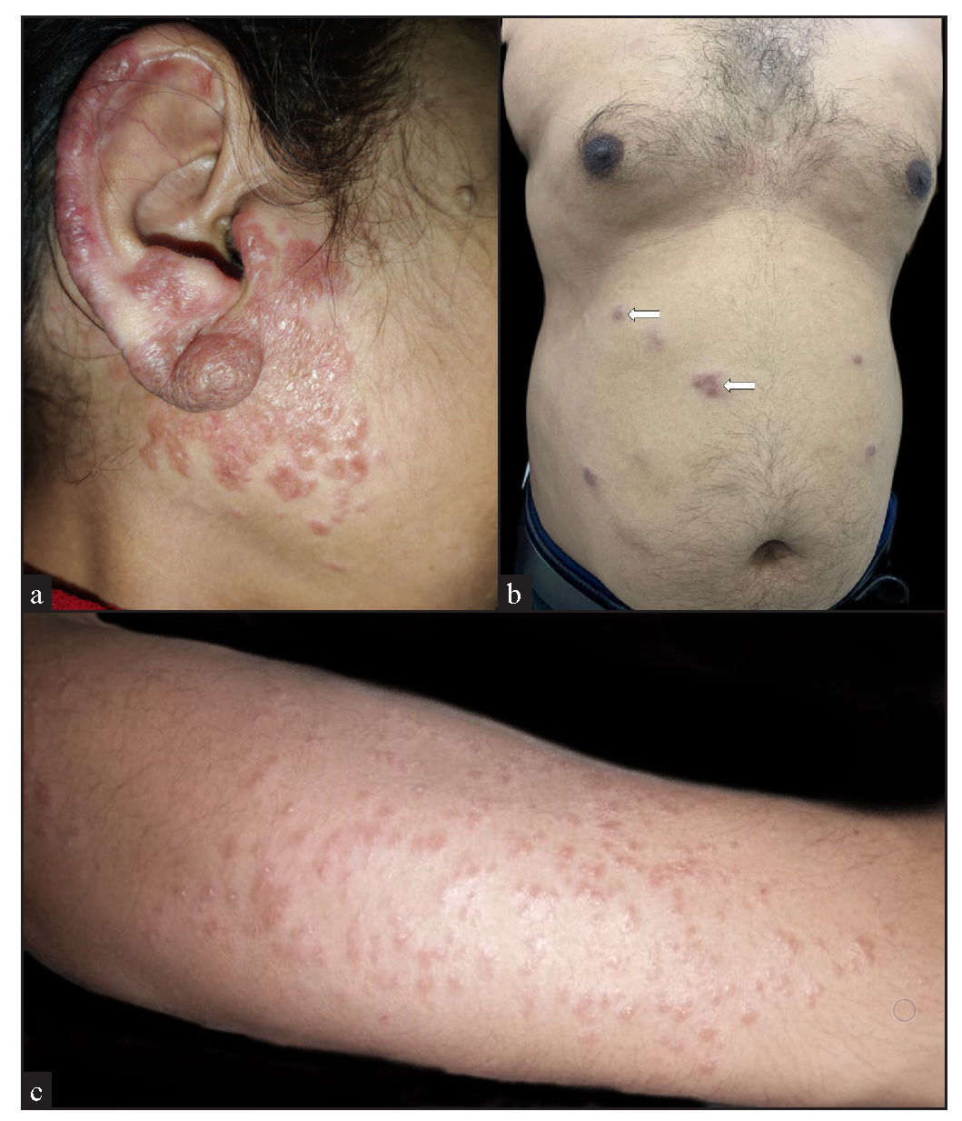 Clinico-histopathological review of cutaneous sarcoidosis: A retrospective descriptive study