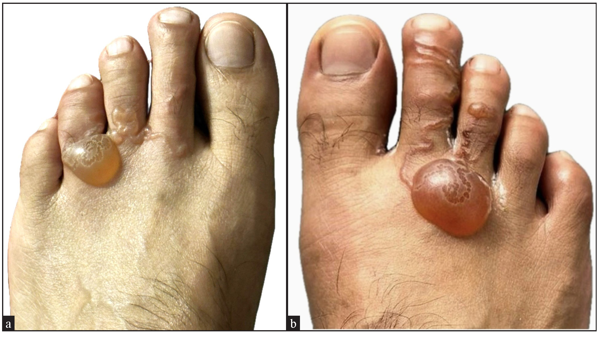 Bullous cutaneous larva migrans