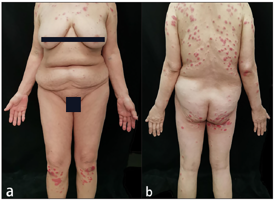 Blastic plasmacytoid dendritic cell neoplasm misdiagnosed and treated as acute febrile neutrophilic dermatosis