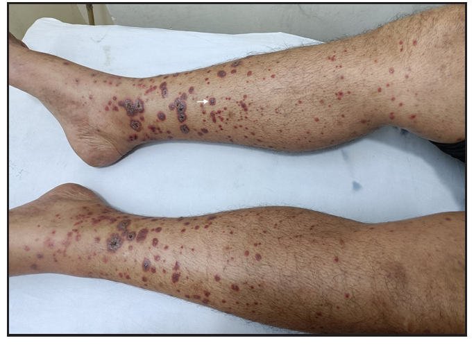 IgA Vasculitis in adults: Importance of recognising diverse cutaneous and systemic manifestations and associations