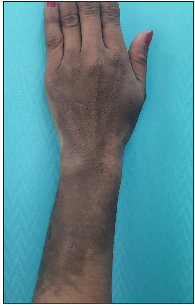 Localised cutaneous siderosis following intravenous ferric carboxymaltose infusion: An underreported complication