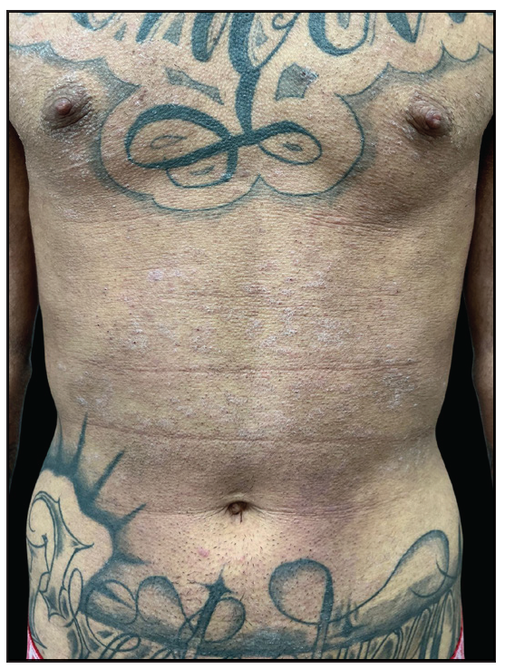 Crusted scabies in an atopic dermatitis patient on treatment with dupilumab