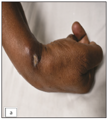 Peripheral neuritis: Tuberculosis as a rare diagnostic contender