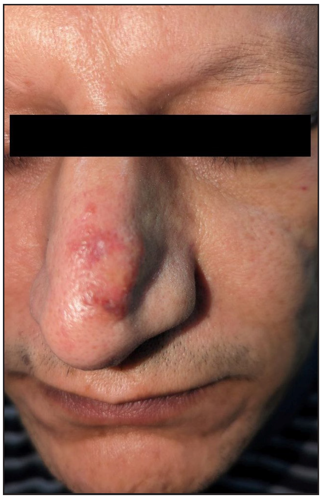 Needle radiofrequency ablation (RFA) and topical tacrolimus combination therapy for primary localised cutaneous nodular amyloidosis