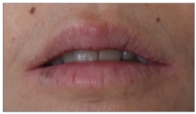 Fractional carbon dioxide laser treatment for refractory exfoliative cheilitis