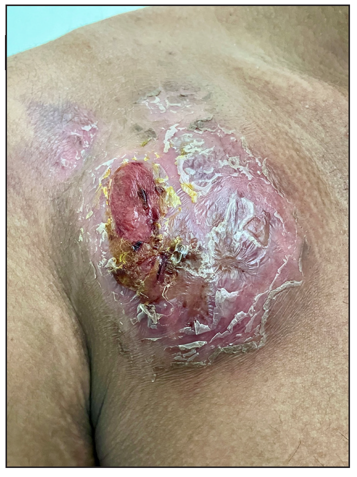 Clear cell anaplastic large cell lymphoma in a young male: A rare lymphoma variant