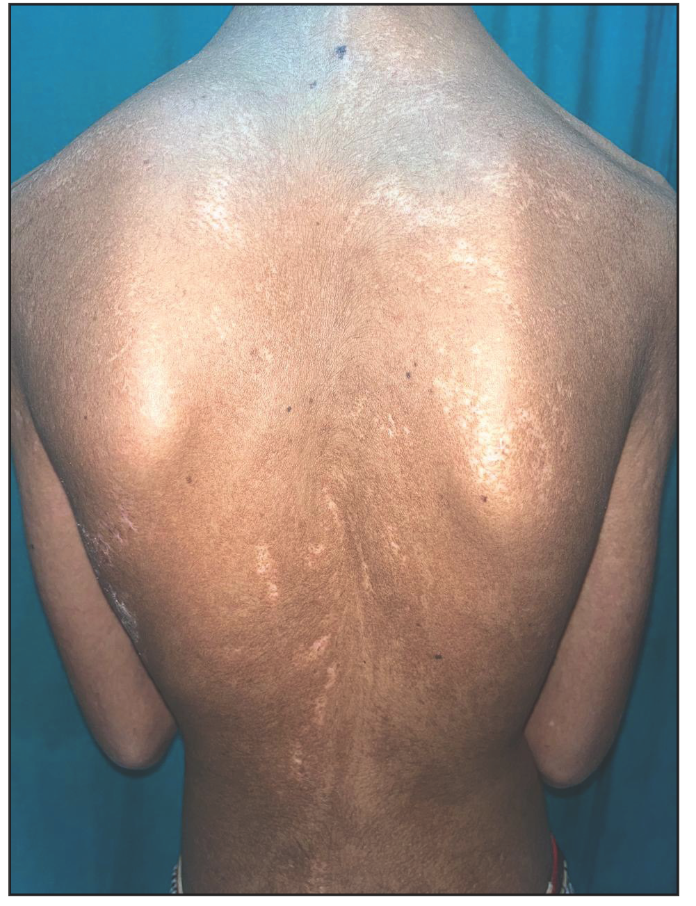 Focal dermal hypoplasia – A report of two cases with review of literature