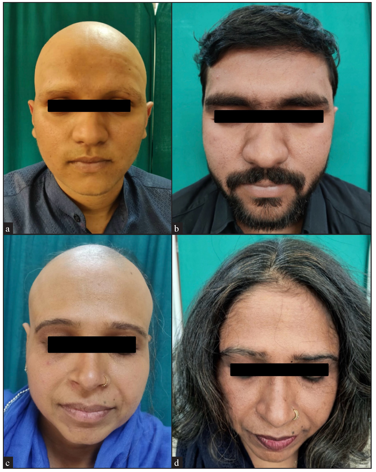 Combination of oral tofacitinib and oral mini-pulse with betamethasone (T-OMP) for the successful treatment of long-standing alopecia universalis: A real-world experience in a recalcitrant disease