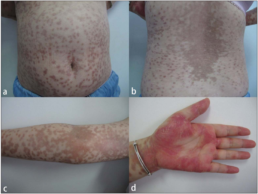 Risk factors associated with chronic cutaneous graft-versus-host disease: A retrospective study