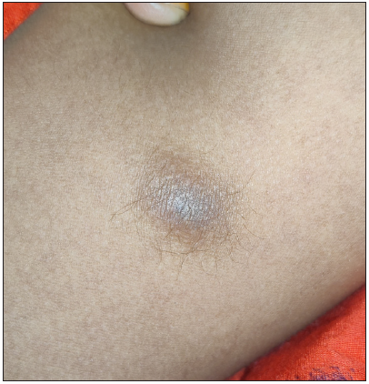 Multiple hairy nodules in an adolescent girl