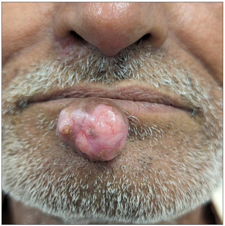 A pedunculated nodule on lower lip