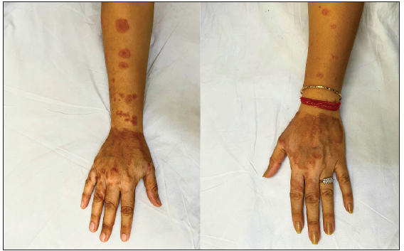 Therapeutic success of tofacitinib in granuloma annulare: A retrospective case series of 15 patients