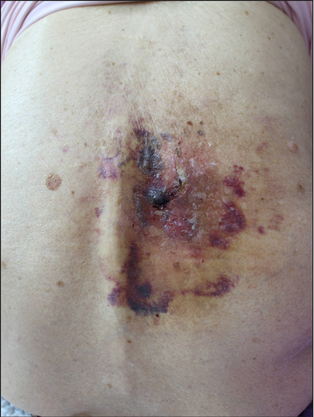 Superficial basal cell carcinoma at the site of herpes zoster: Wolf’s isotopic response or idiopathic?