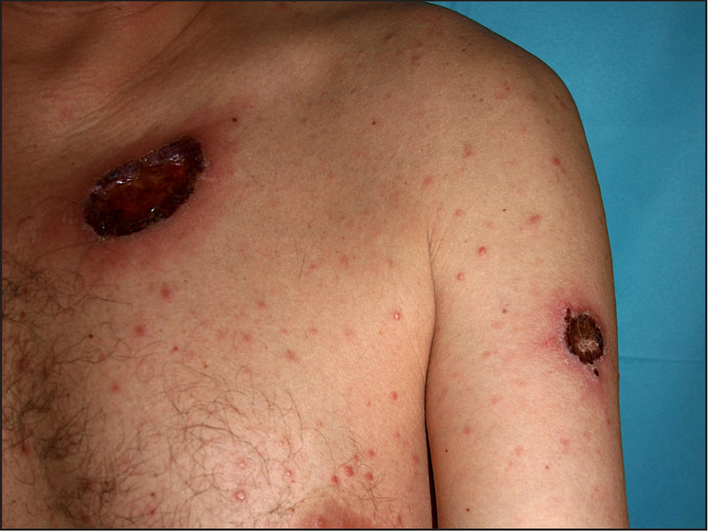 Lues maligna and HIV mimicking aggressive epidermotropic CD8+ cutaneous T-cell lymphoma