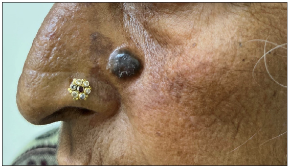 Clinico-epidemiological characteristics and long-term surgical outcome of basal cell carcinoma treated with standard excision in patients of skin of colour: A retrospective study from Northern India