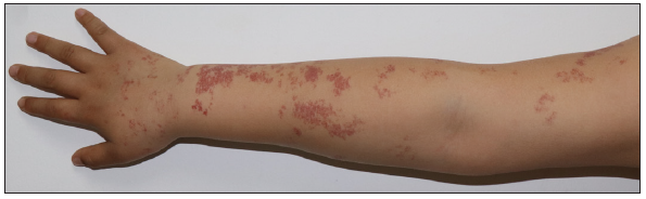 Unilateral naevoid telangiectasia: A retrospective study of 11 paediatric cases