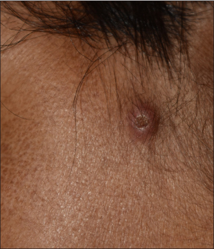 Dermoscopic evaluation of cutaneous histoplasmosis