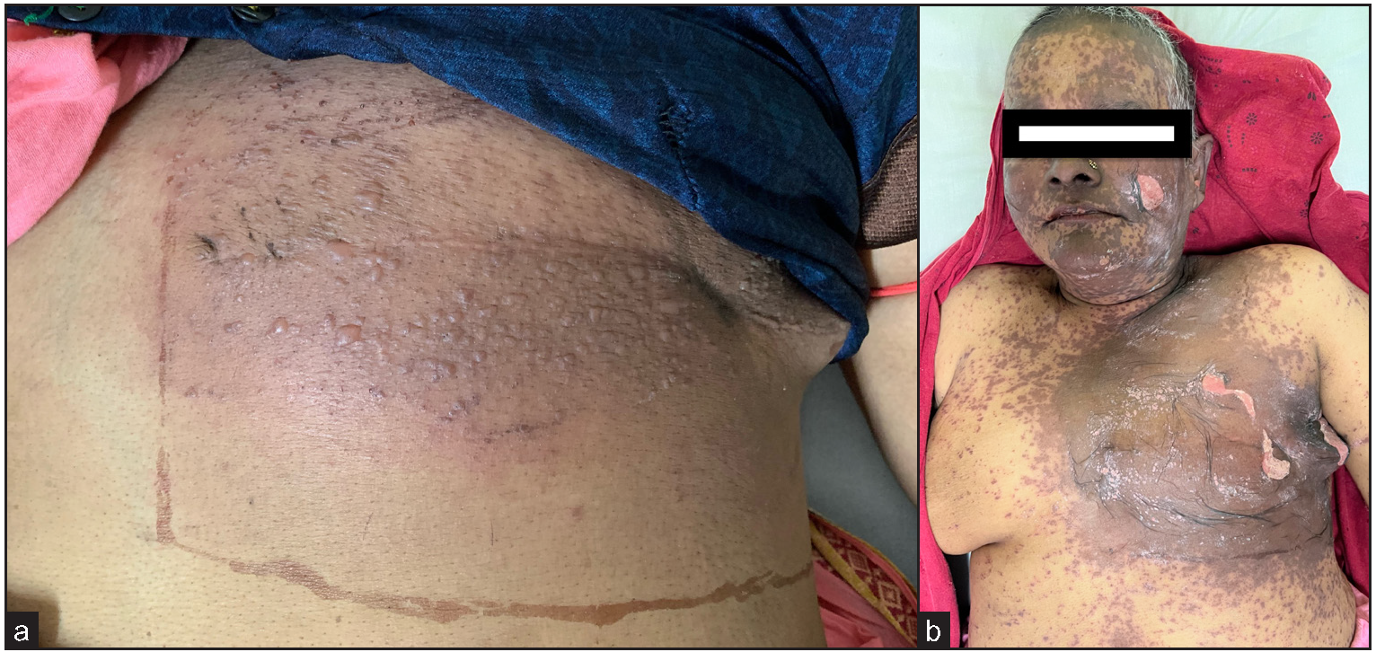 Toxic epidermal necrolysis predominantly involving irradiated site in a carcinoma breast patient – An example of immunocompromised cutaneous district