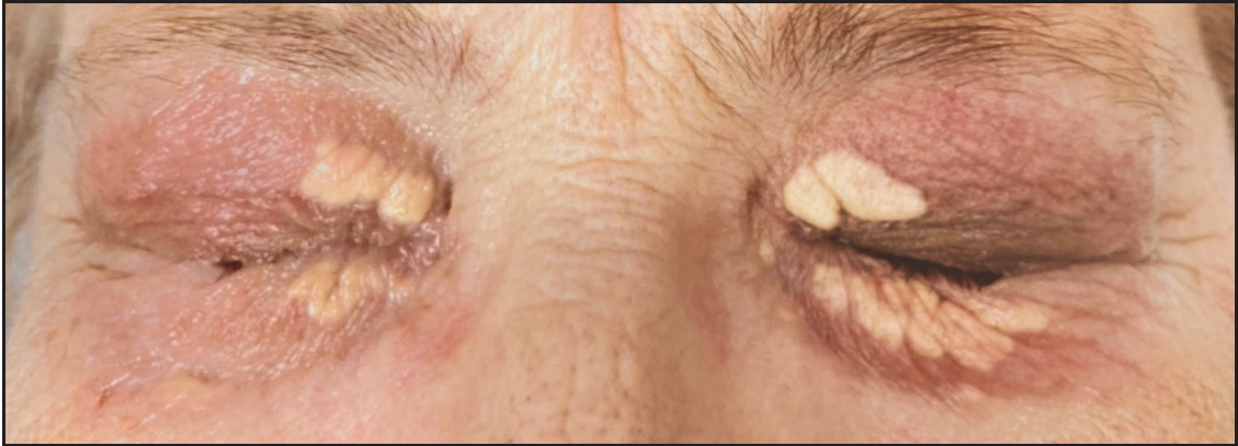 Successful treatment of xanthelasma palpebrarum grade III with copper vapour laser radiation (578 nm)