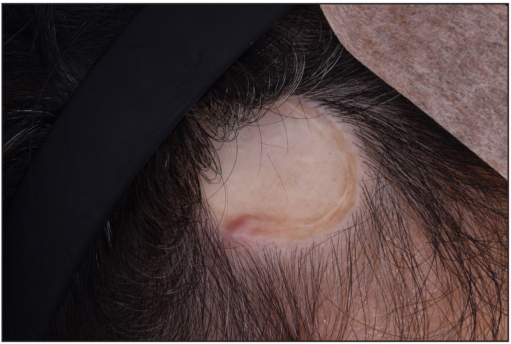 Development of metastatic lung adenocarcinoma in a twenty-year-old skin graft site on the scalp: A case report