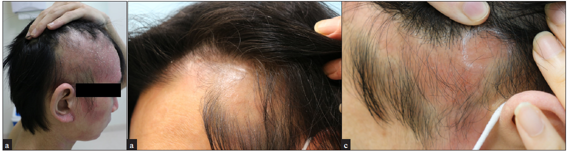 Exacerbation of head and neck eczema with new-onset alopecia following dupilumab treatment in severe atopic dermatitis patients: A case series