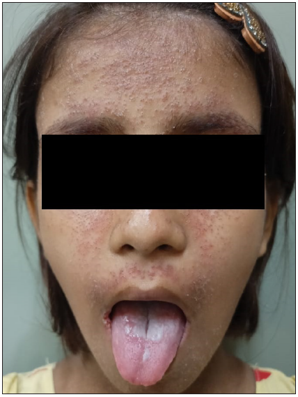 A novel mutation in autoimmune polyglandular syndrome type 1 with erythematous facial papules