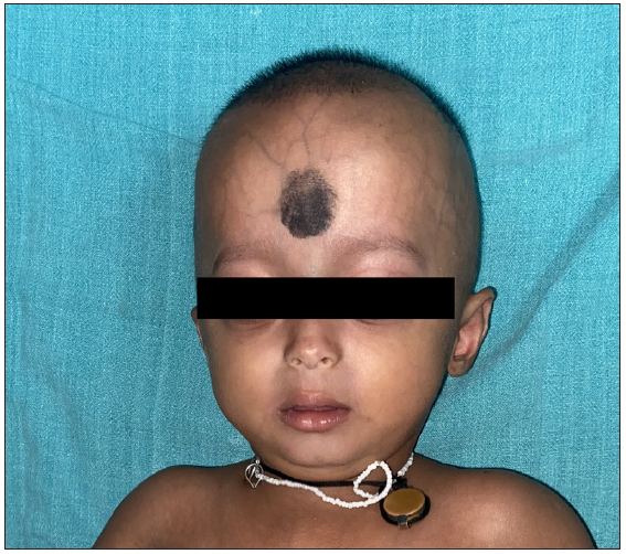 Reticulate sclerodermoid pigmentation in Hutchinson–Gilford progeria syndrome – A report of two cases