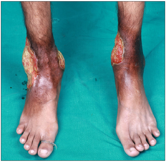 Non-healing leg ulcers in HbE-beta thalassemia