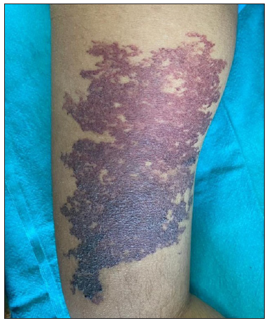 Successful treatment of capillary malformation with foam sclerotherapy