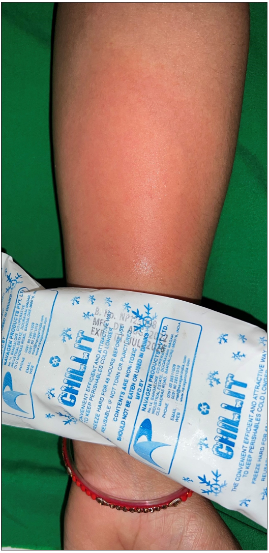 Cold urticaria in tropics: A clinico-epidemiological study from North India