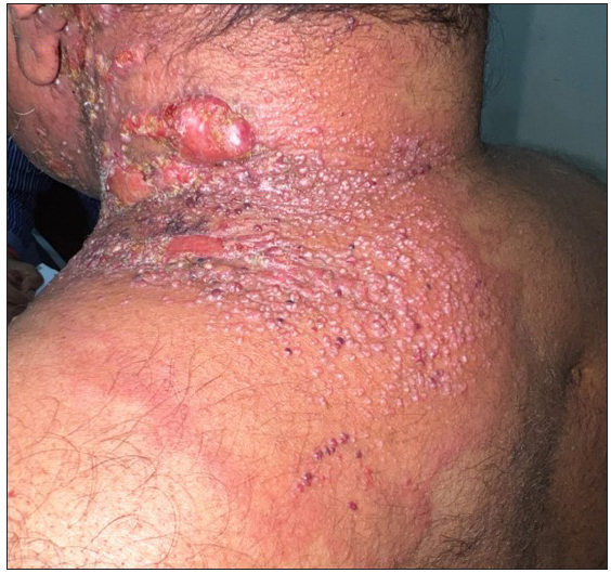 Zosteriform lymphangitis carcinomatosis: A dermatologist’s enigma