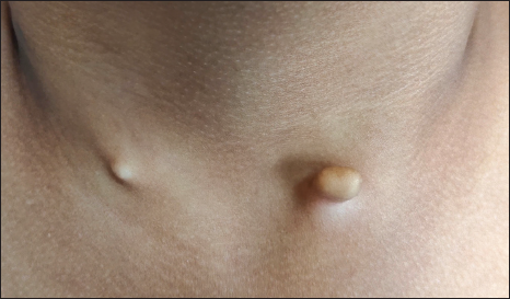 Bilateral congenital cartilaginous rest of the neck: A rare presentation of accessory tragus