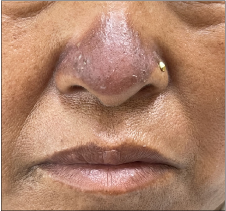 Scratch amyloidosis over nose: A rare site of cutaneous amyloidosis