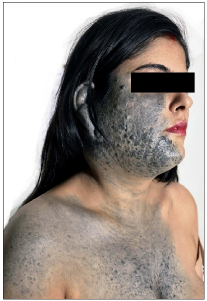 Large plaque-type blue naevus with subcutaneous cellular nodules (LPTBN-SN) in a young female: A rare entity