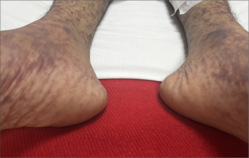 Fulminant Neisseria septicemia with secondary hemophagocytic lymphohistiocytosis