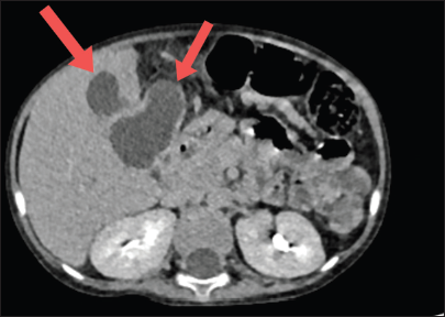 Isolated fungal liver abscess in pediatric acute lymphoblastic leukemia – A case report