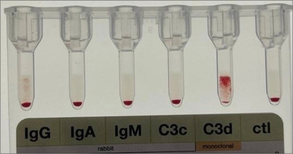 Cold agglutinin syndrome secondary to Mycoplasma pneumoniae