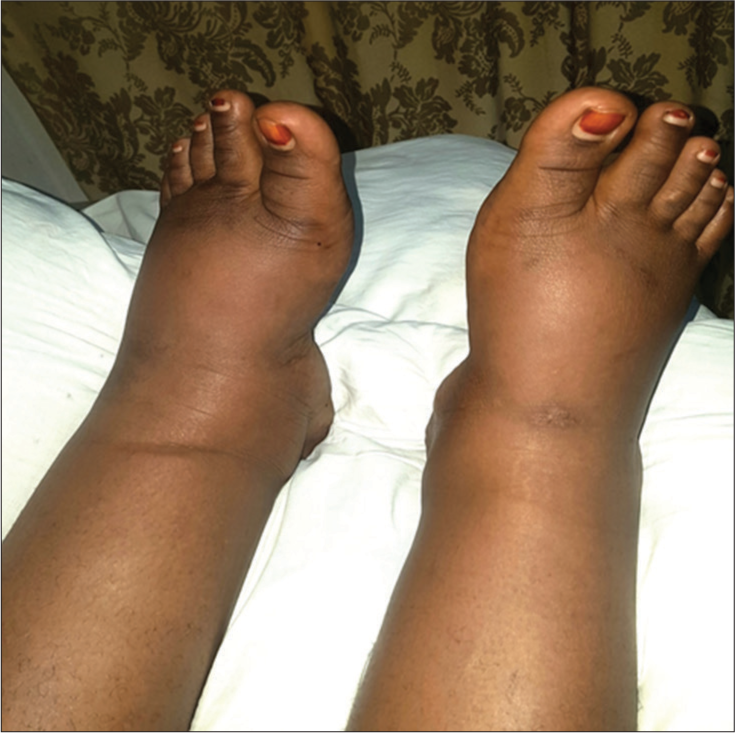 Physical therapy in post-thrombotic syndrome: A case report