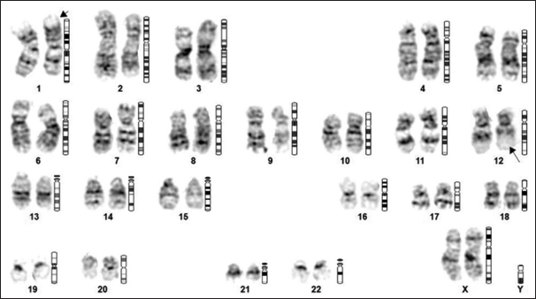 t (1;12) (p31; q13) cytogenetic abnormality in a patient of idiopathic hypereosinophilic syndrome: A case report