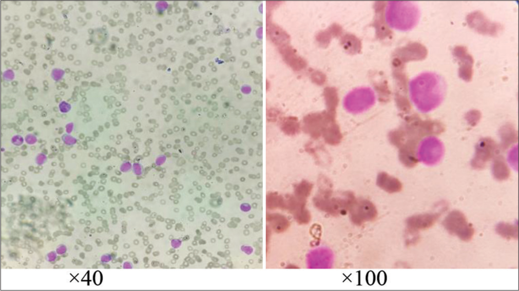 Acute leukemia manifesting as a pericardial effusion in a pregnant female: A rare event