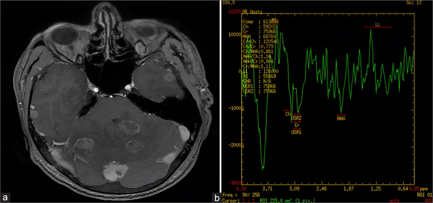 Marked leukemoid reaction preceded the onset of meningitis: A case report