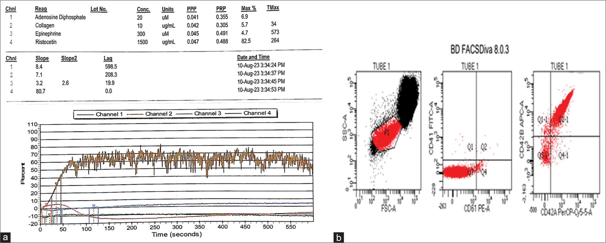 Inherited platelet function disorders in children – A diagnostic conundrum solved by multimodality testing