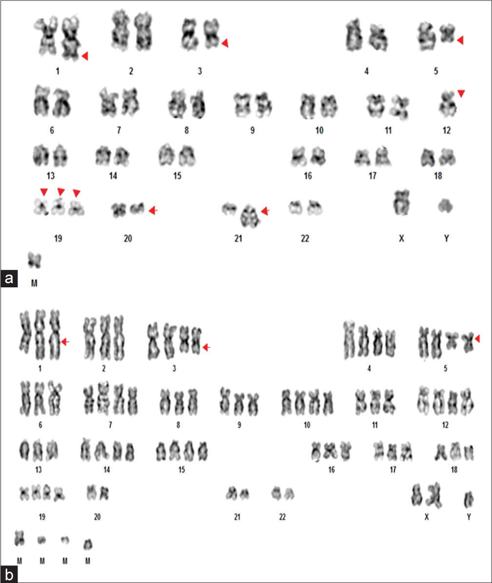 Genetic complexity in myelodysplastic syndromes: Insights from a case with complex karyotype and renal manifestations