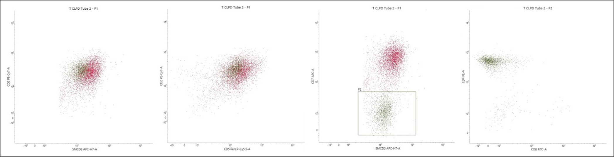 A case report of peripheral T-cell lymphoma presenting as autoimmune hemolytic anemia