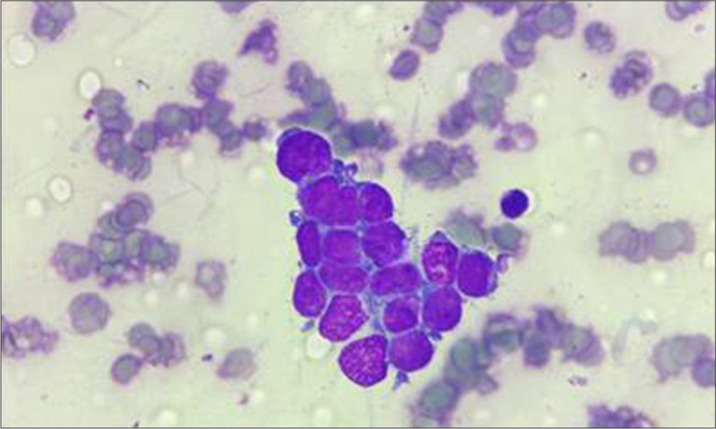 Rare cytogenetic subtype in a case of Ewing sarcoma with diagnostic dilemma: A case report