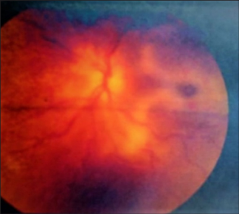 Central retinal artery occlusion in a young adult with sickle cell disease