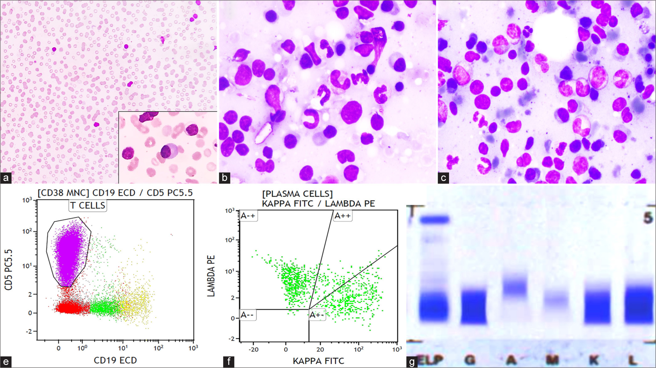 Multicentric Castleman disease involving the bone marrow in an immunocompetent patient masquerading as a non-Hodgkin lymphoma – A diagnostic conundrum