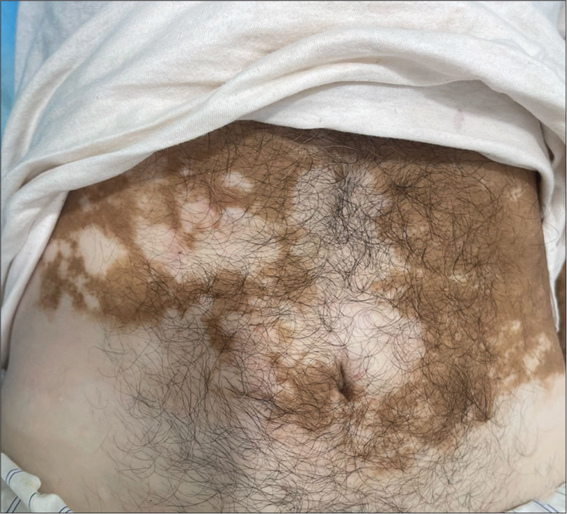 Barely visible yet intensely felt Itch: Dermoscopy clinches the diagnosis