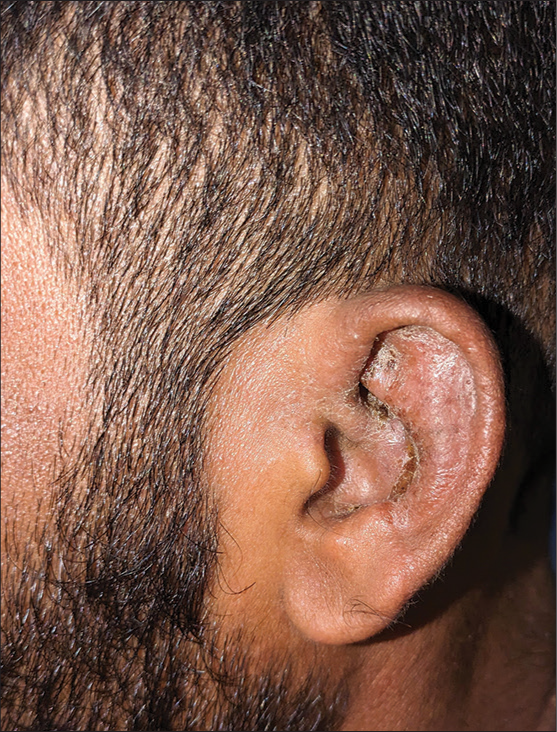 Otitis externa caused by an exotic organism – Otodectus cynotis